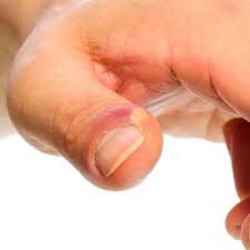 Home Remedies For Whitlow